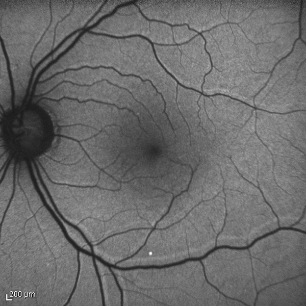 anesthesia for retina detachment surgery elderly