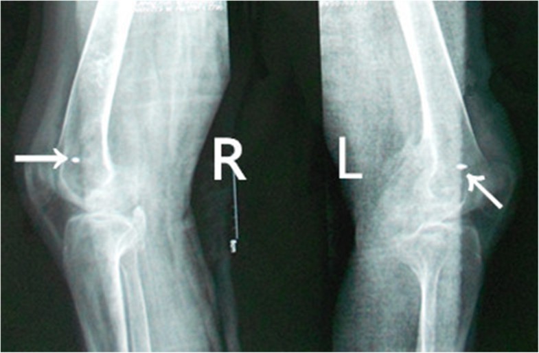 Acquired heterotopic ossification in hips and knees following