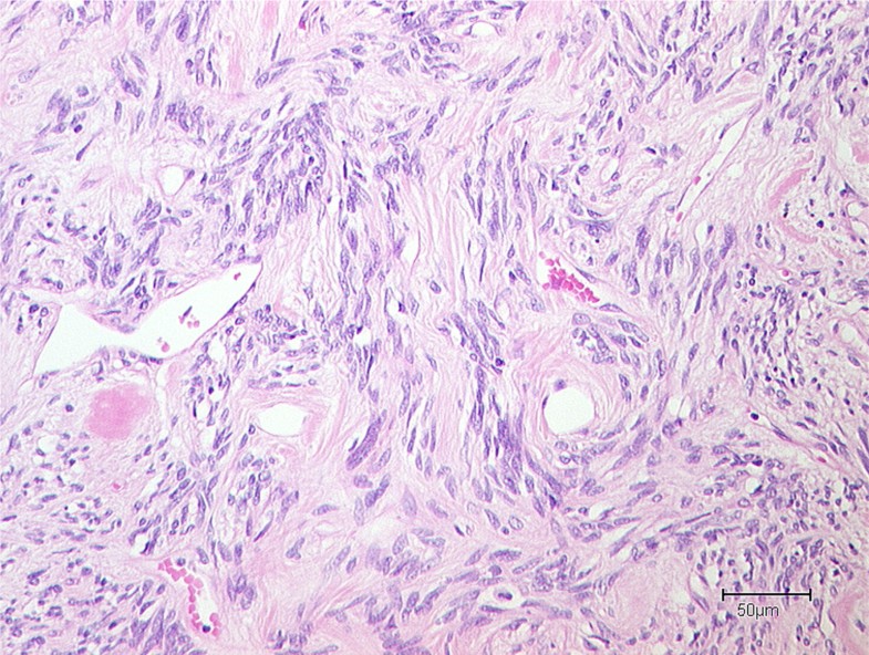 Pathology Outlines Solitary Fibrous Tumor Extrapleural
