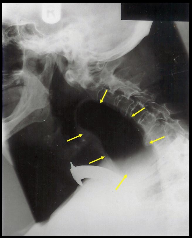 Laryngocele a rare complication of surgical tracheostomy BMC Surgery
