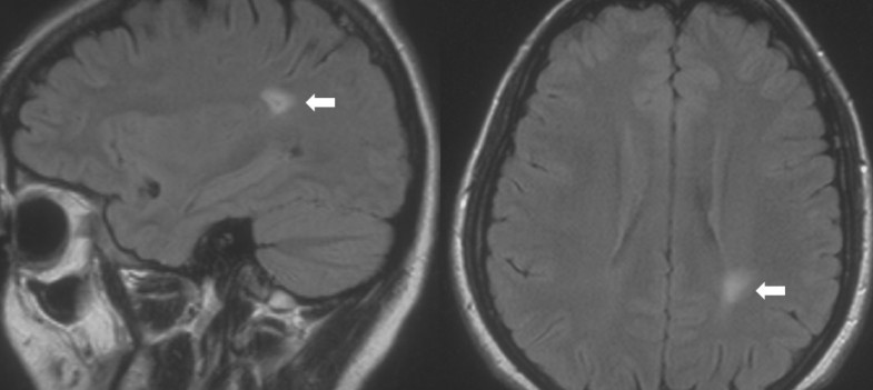 mri of internal auditory canal images which cranial