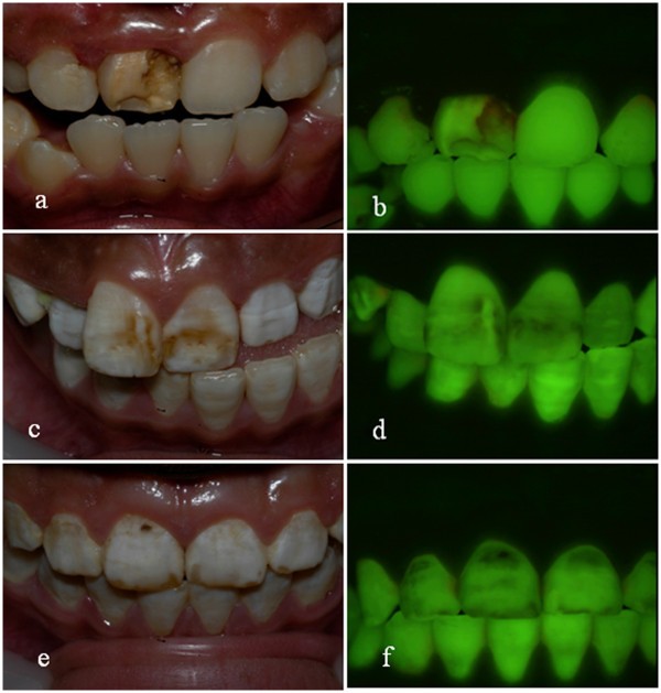 Dental fluorosis in populations from Chiang Mai, Thailand with