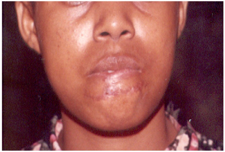 Human bite injuries in the orofacial region at the Muhimbili National