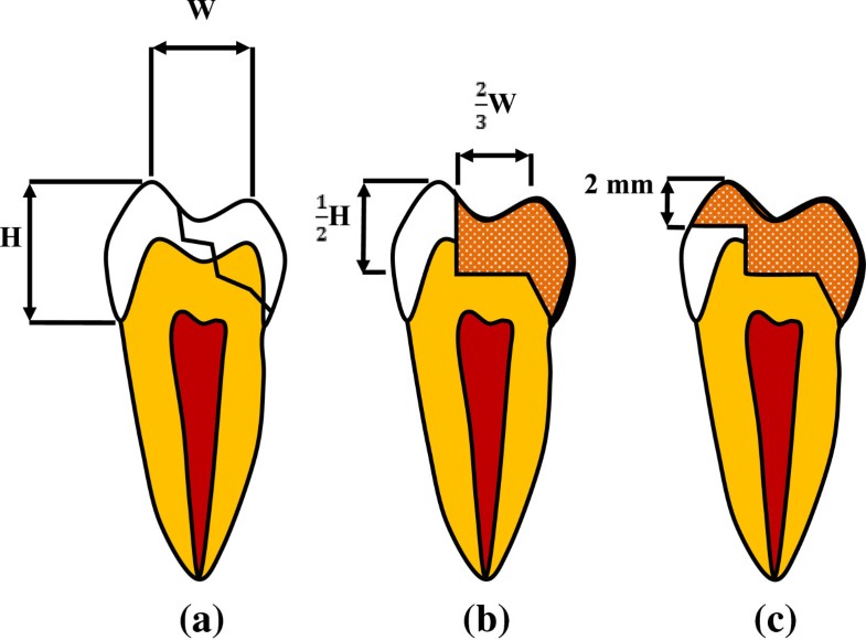 Examination of ceramic restoration adhesive coverage in cusp