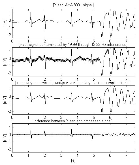 Suppression of AC railway power-line interference in ECG signals ...
