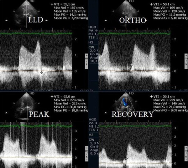 Clinical applications of exercise stress echocardiography in the