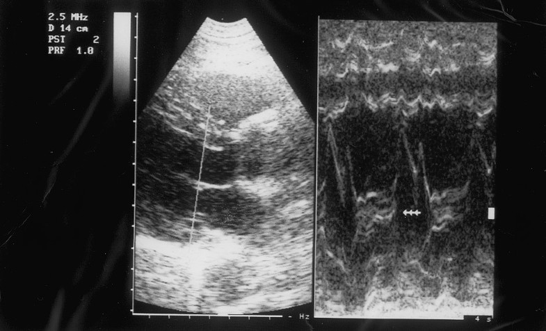 Mitral valve prolapse associated with celiac artery stenosis: a new