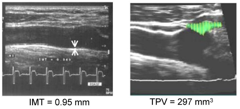 Relationship Of The Metabolic Syndrome To Carotid Ultrasound Traits