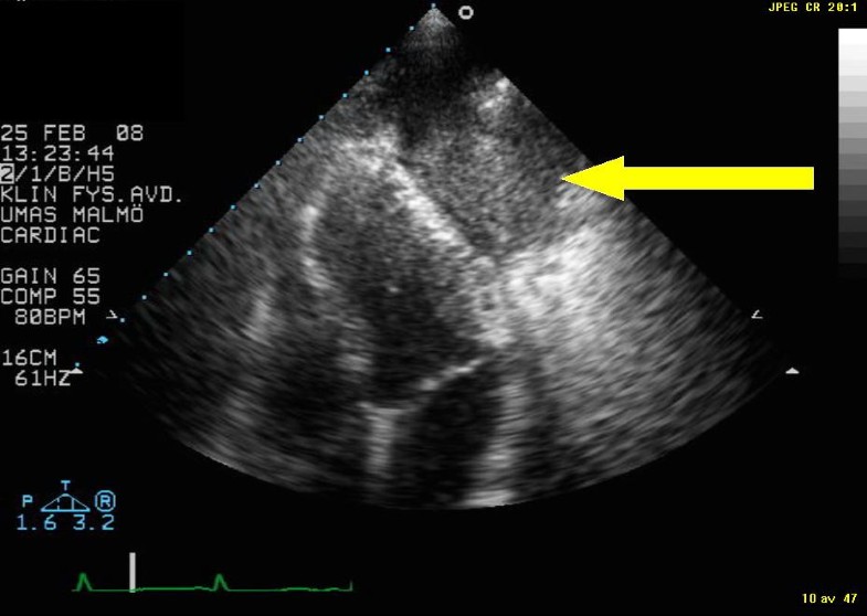 Primary lung tumour visualised by transthoracic echocardiography
