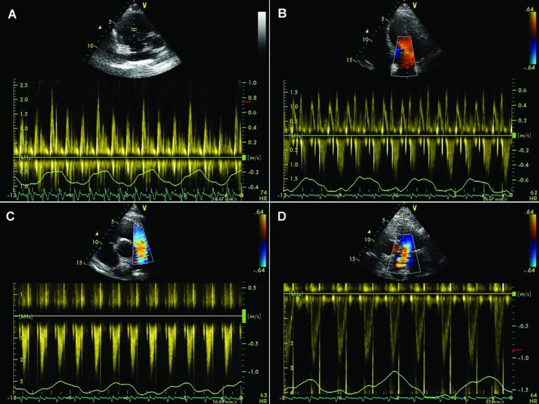 Respiratory maneuvers in echocardiography a review of clinical