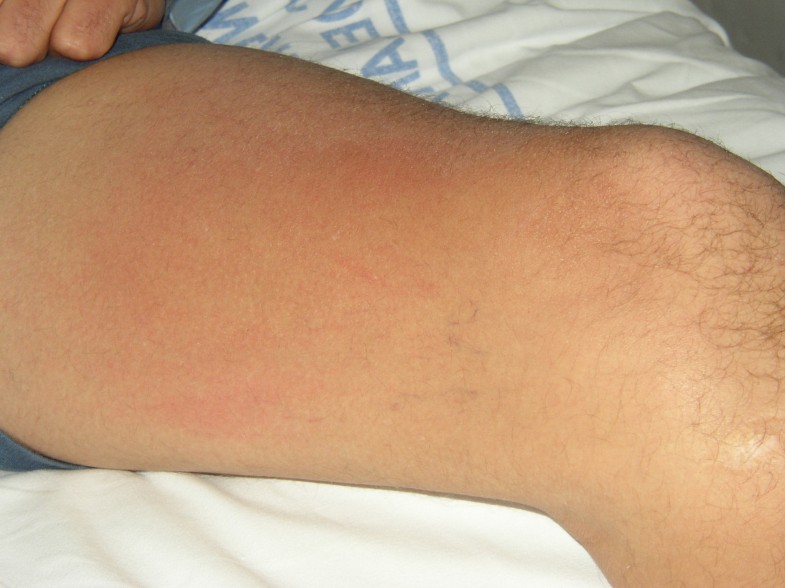 Insulin allergy and resistance successfully treated by desensitisation