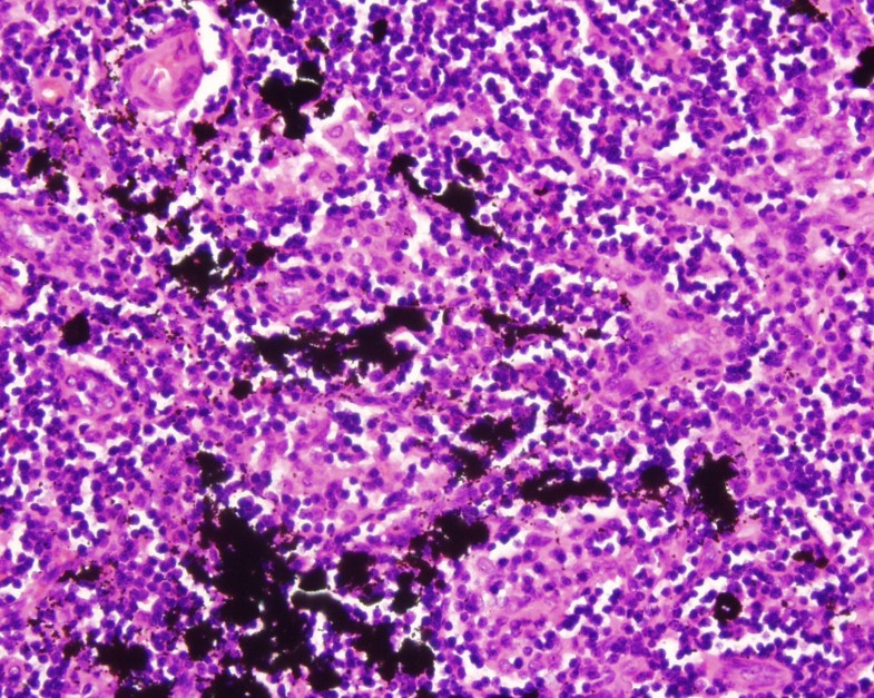 Tattoo pigment in an axillary lymph node simulating metastatic