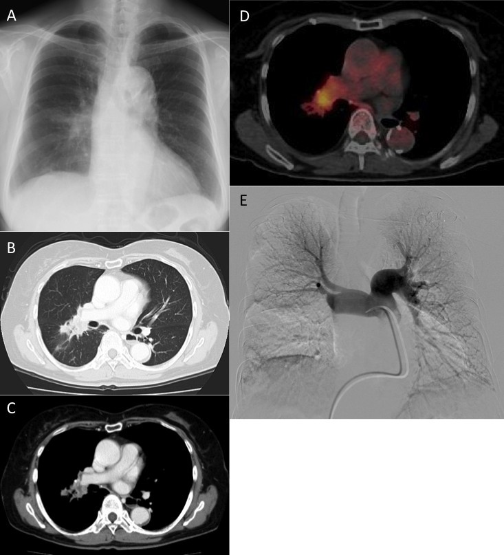 Lung adenocarcinoma with peculiar growth to the pulmonary artery and ...