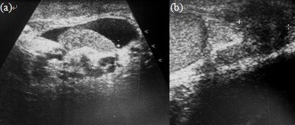 Malignant mesothelioma of the tunica vaginalis testis: a malignancy