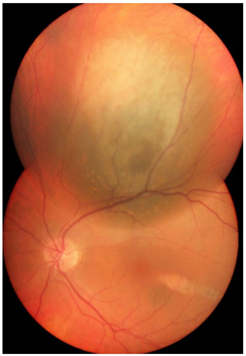 ocular-melanoma-in-a-patient-successfully-treated-for-diffuse-malignant