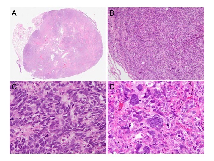 Combined large cell neuroendocrine carcinoma with giant cell carcinoma of the lungs a case