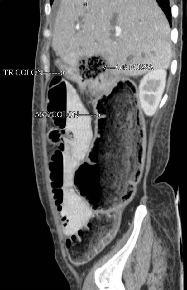 Transmural invasion of hepatic flexure of colon causing cholecystocolic
