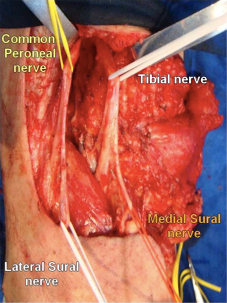 Popliteal lymph node dissection for metastases of cutaneous malignant