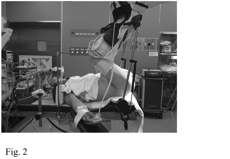 Perineal approach for a gastrointestinal stromal tumor on the anterior
