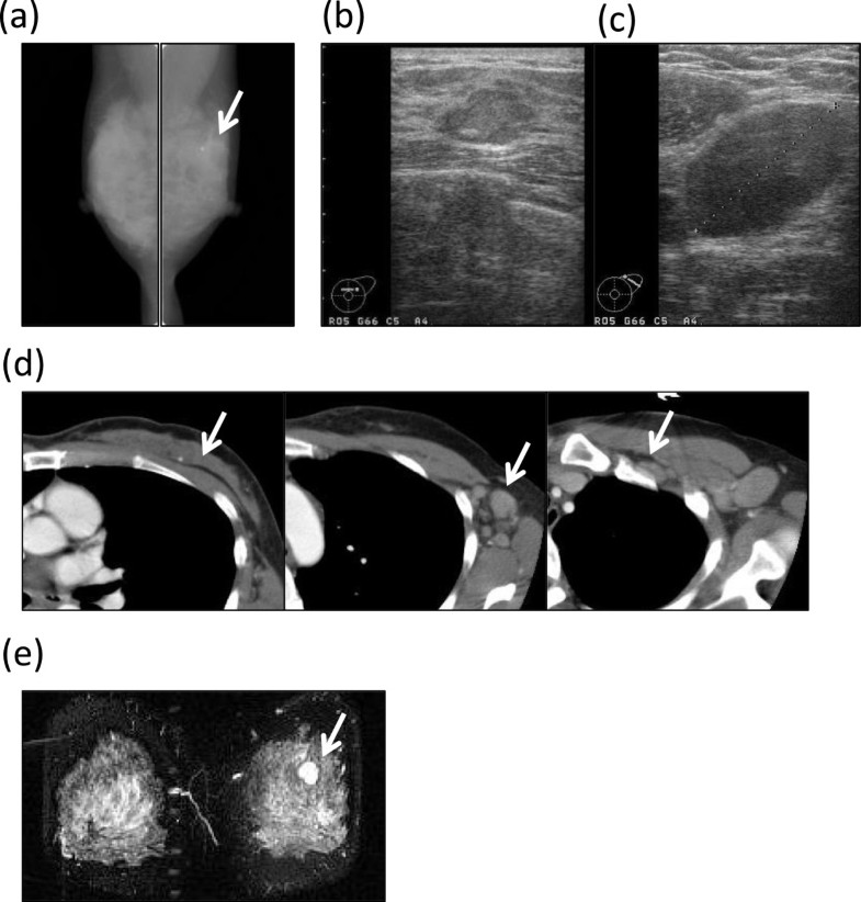 A case of invasive micropapillary carcinoma of the breast involving