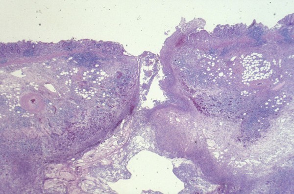 post ercp pancreatogastric fistula associated with an intraductal