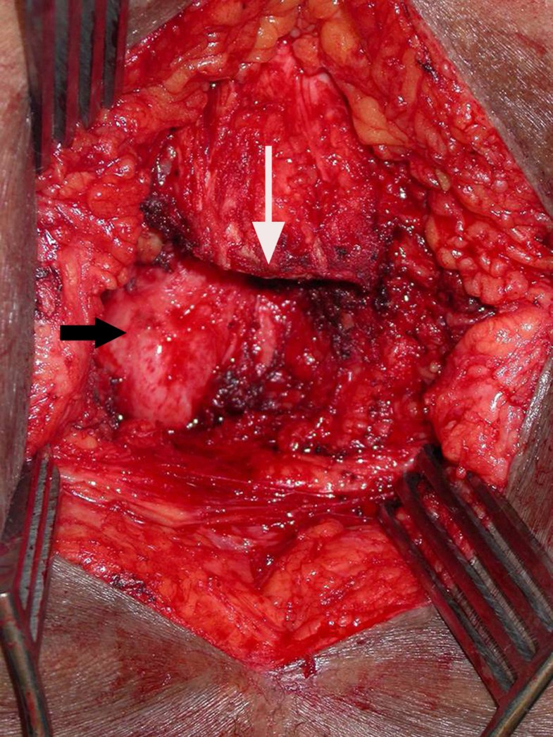 Primary presacral neuroendocrine tumor associated with imperforate anus