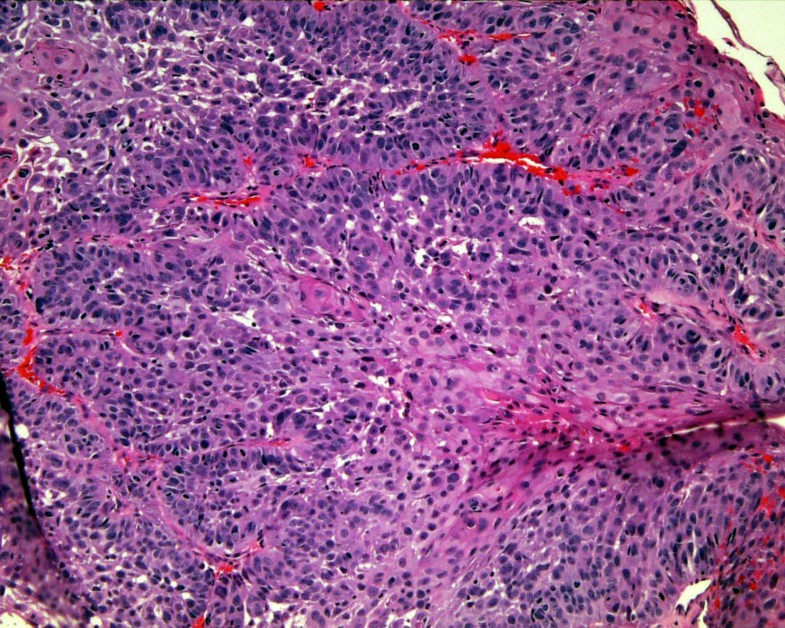 Cryospray ablation (CSA) in the palliative treatment of squamous cell
