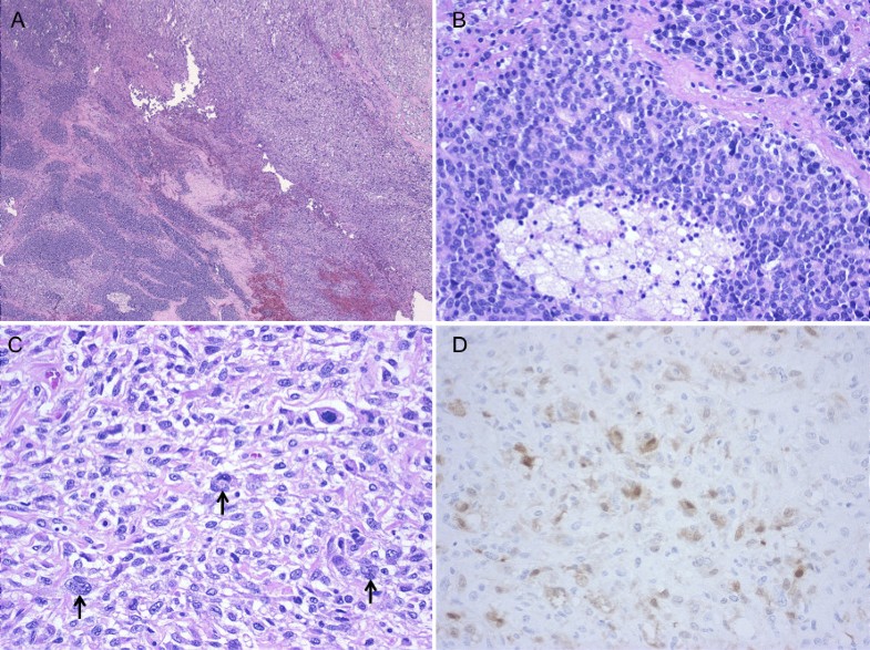 Solitary pulmonary metastasis from prostate sarcomatoid ...