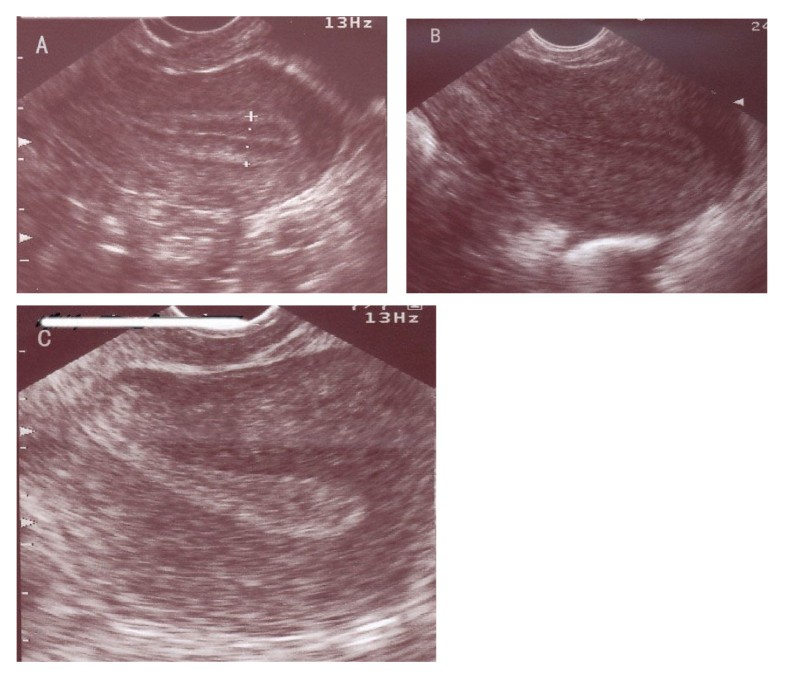 Combined analysis of endometrial thickness and pattern in predicting