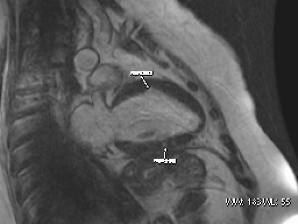 Delay Enhancement Cardiac Mr Imaging For Assesment Of - 