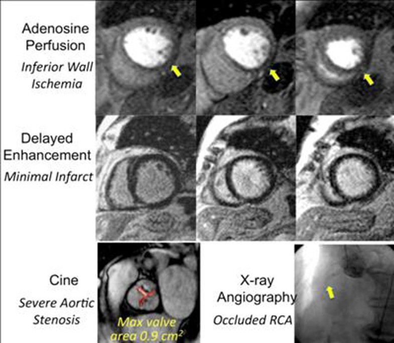 Safety of adenosine stress perfusion cardiac resonance imaging in patients with aortic