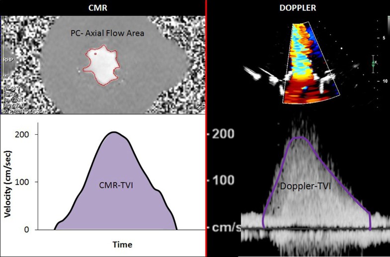 Bioprosthetic mitral valve effective orifice area by phasecontrast CMR