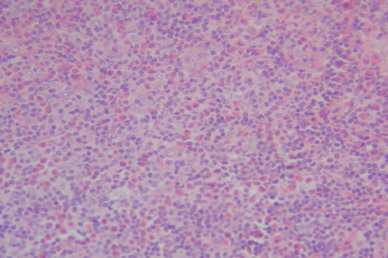 Kimura's disease with eosinophilic panniculitis treated with