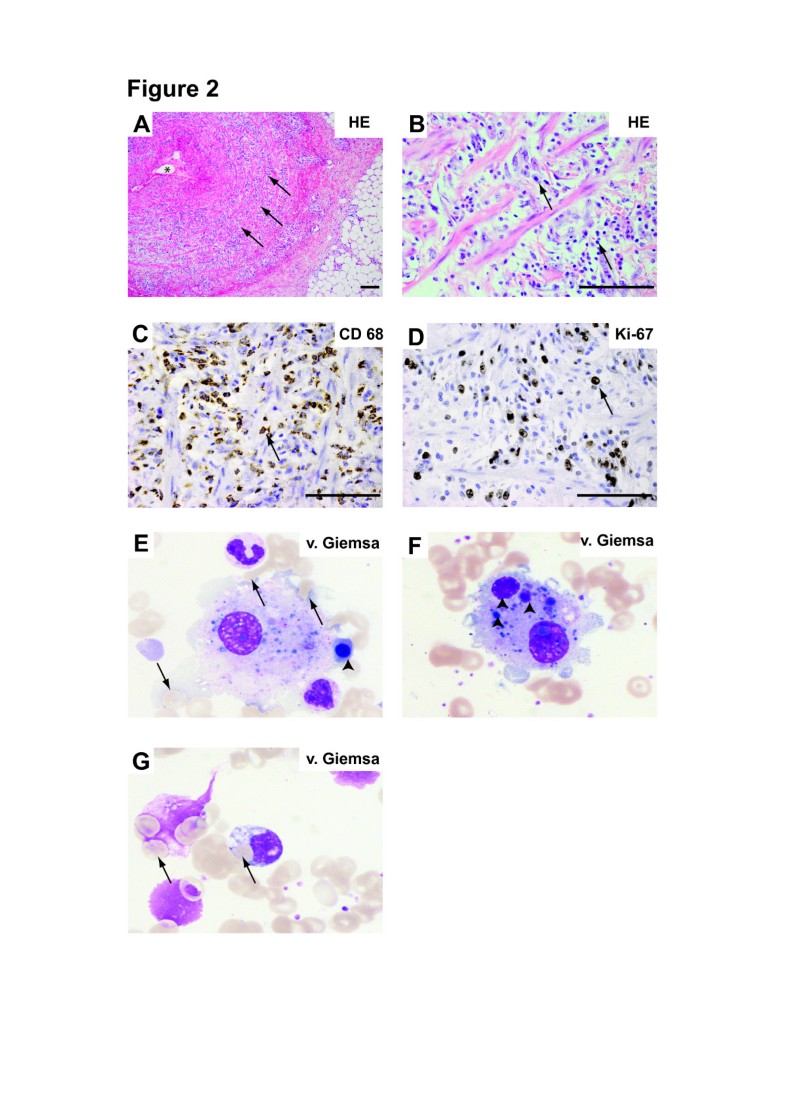 Macrophage activation syndrome in a patient with pulmonary inflammatory ...