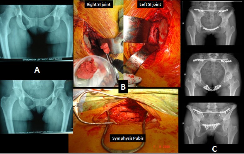 Pregnancy-related pelvic girdle pain: an update | BMC Medicine | Full Text
