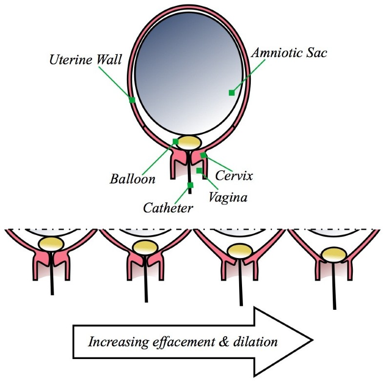 A simplified cervix model in response to induction balloon in pre
