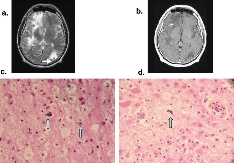 Cerebral microsporidiosis manifesting as progressive multifocal leukoencephalopathy in an HIV