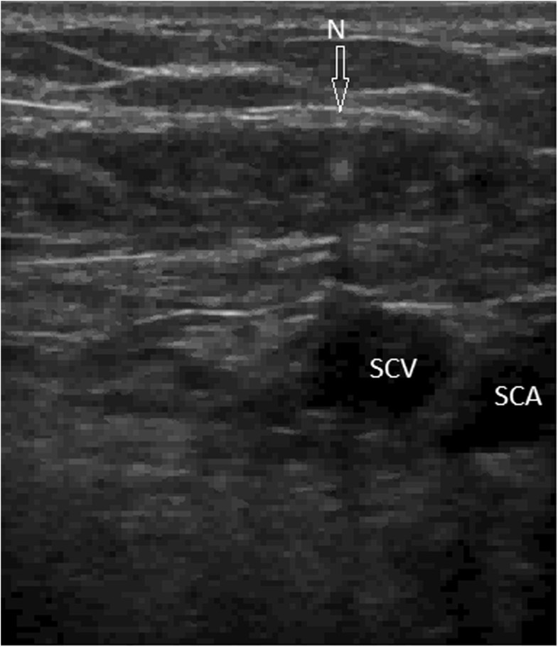 Guidance And Examination By Ultrasound Versus Landmark And Radiographic ...