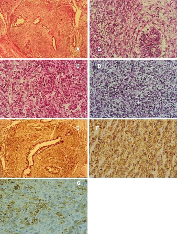 Breast spindle cell tumours about eight cases Diagnostic Pathology