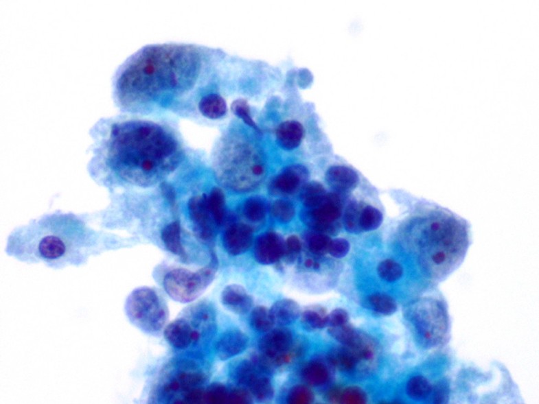 Thymomas: a cytological and immunohistochemical study, with emphasis on ...