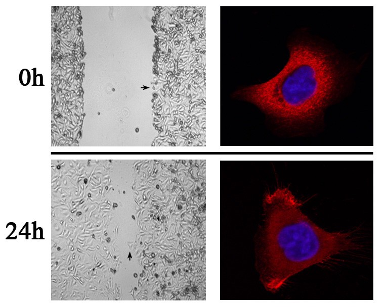 Ezrin overexpression predicts the poor prognosis of ...