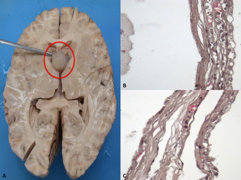 Colloid cyst of the third ventricle, hypothalamus, and heart: a