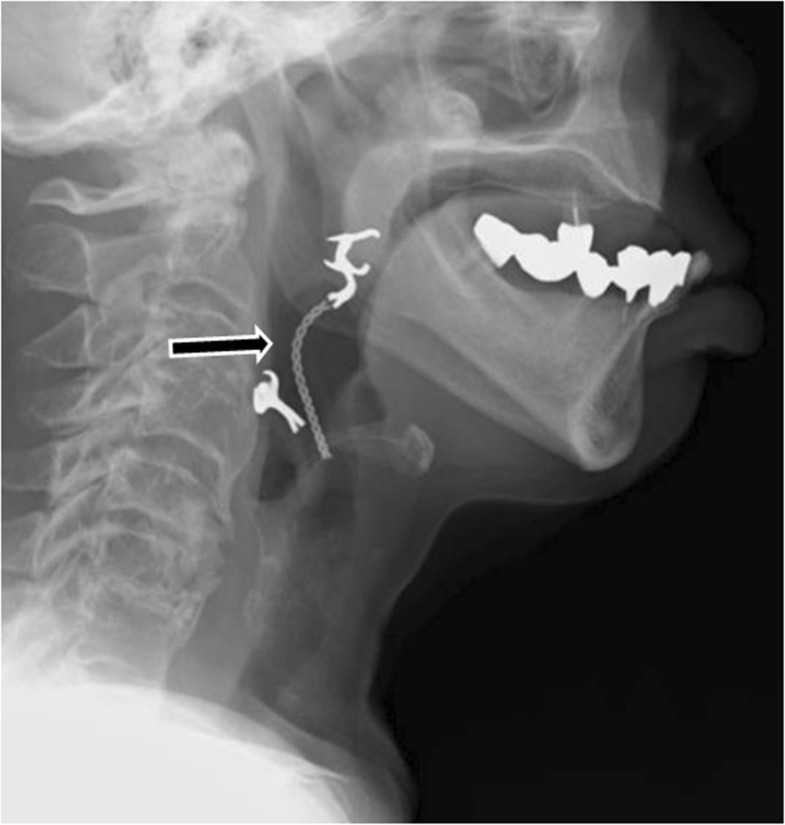 Dislocated dental bridge covering the larynx usefulness of tracheal