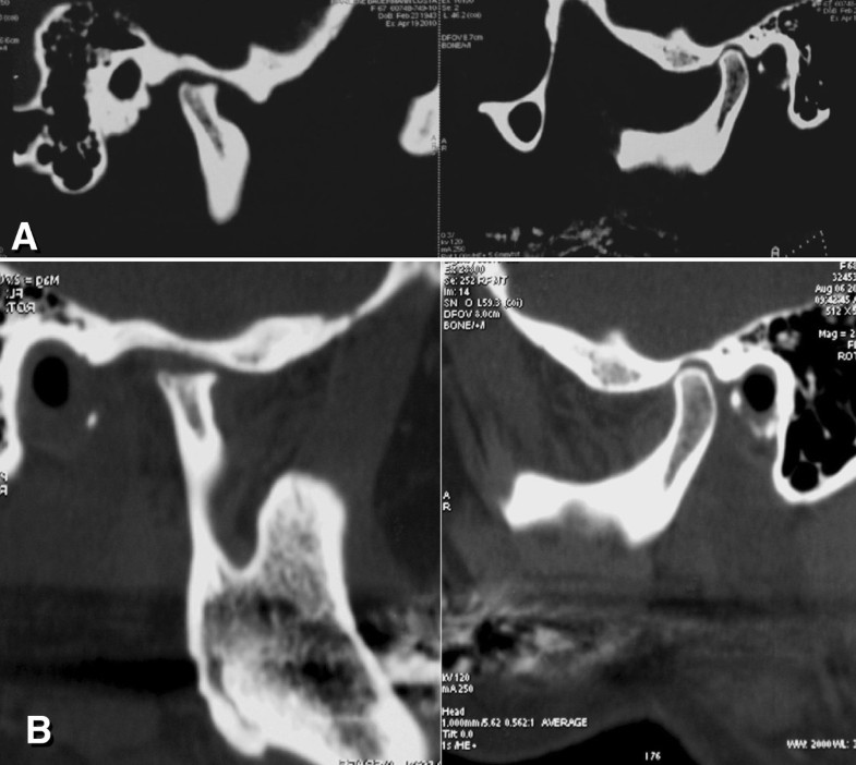 Clinicalsurgical treatment of temporomandibular joint disorder in a