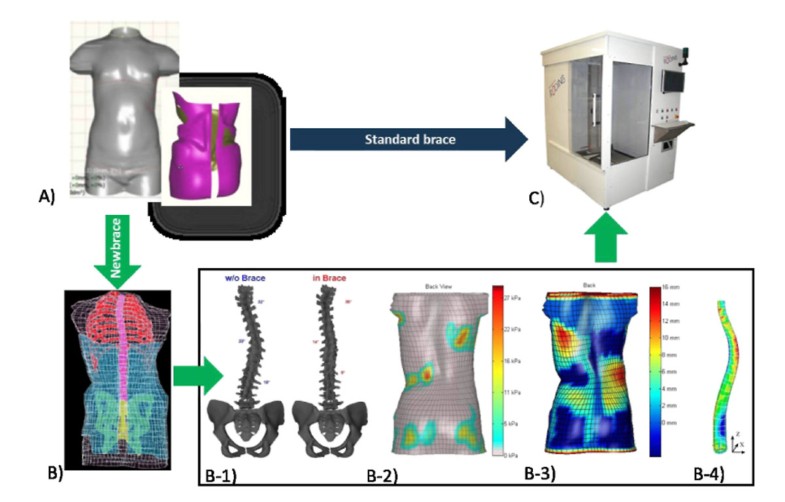 Improved brace design combining CAD/CAM and finite element simulation ...