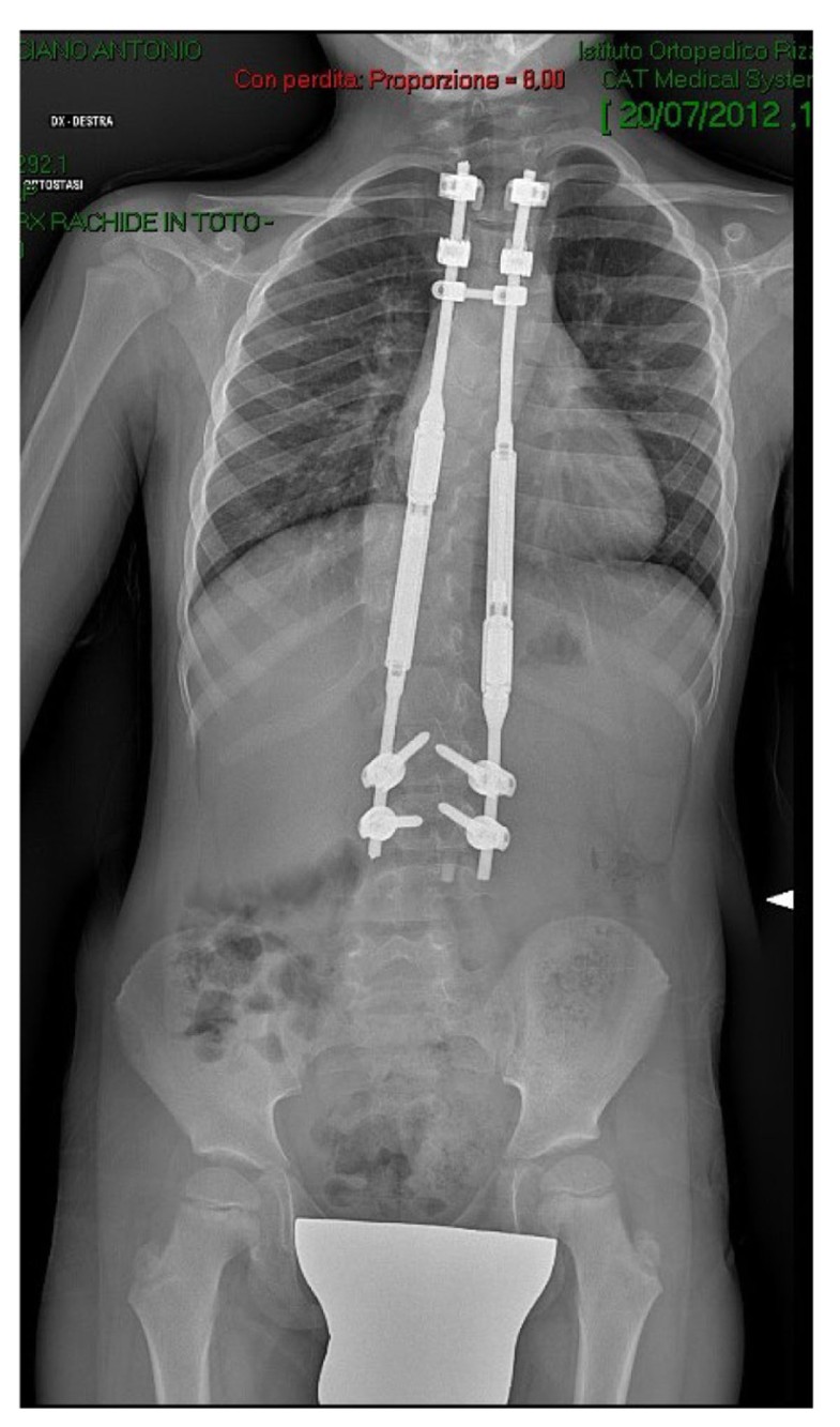 controlled growing rod in early onset scoliosis