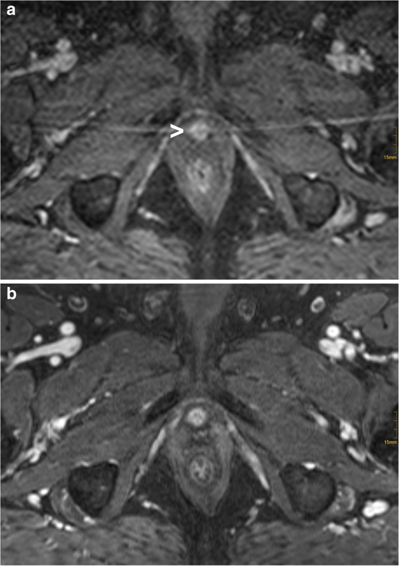 Detection of local recurrent prostate cancer after radical