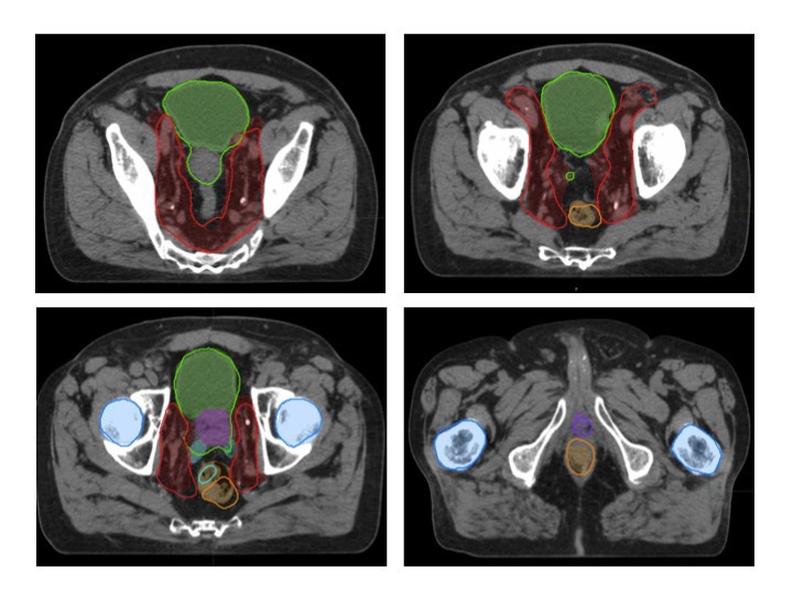 Rtog Rni Atlast Rtog 0529 Contouring Atlas , NRG Oncology Updated International ...