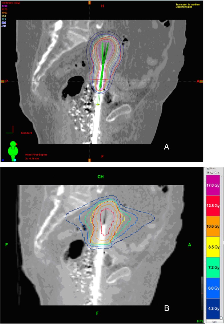 fraction 3 x 9 3 2 in body of stereotactic feasibility radiation Dosimetric fraction 3 x 9 3 2 in body of stereotactic feasibility radiation Dosimetric