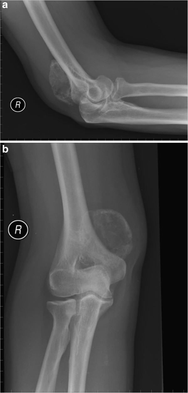 Giant solitary synovial osteochondromatosis of the elbow causing ulnar nerve neuropathy a case